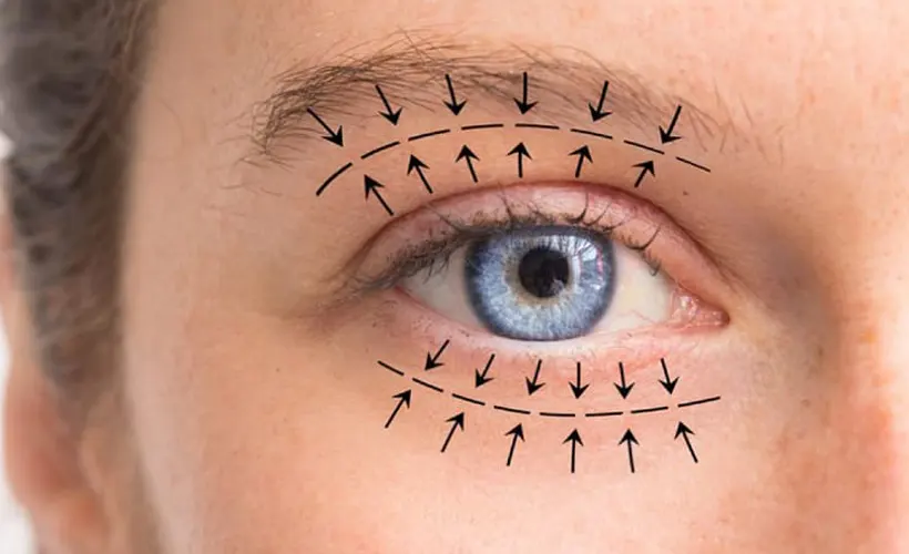 Göz kapağı estetiği